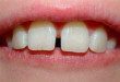 Bọc răng sứ alumina cho hàm răng thưa có tốt không?