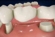 Răng sứ cao cấp – Điểm 10 của sự hoàn hảo đến từng minimet