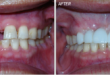 Bọc răng sứ dresden – Giải pháp cho hàm răng xấu xí, kém thẩm mỹ