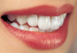 Làm răng sứ 4 cái | Chi phí và quy trình thực hiện như thế nào???