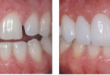 Bọc răng sứ cercon có những ưu nhược điểm nào? << XEM NGAY
