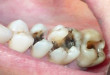 [GÓC TƯ VẤN] Có nên bọc răng sứ không? – CHUYÊN GIA trả lời