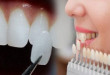 Dán răng sứ thẩm mỹ – Giải pháp cho hàm răng trắng đẹp tự nhiên nhất