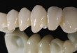 Răng sứ venus cho hàm răng trắng đều vượt thời gian