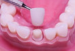 Bọc răng sứ có hại gì không? Chuyên gia uy tín hàng đầu giải đáp