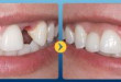 Có nên làm cầu răng trong trường hợp mới bị mất răng?