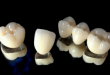 Bọc răng sứ titan có tốt không và độ bền răng sứ titan như thế nào?