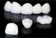 Bật mí cho bạn sự thật về tuổi thọ của răng sứ titan