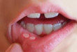 Lở miệng bao lâu thì khỏi phụ thuộc vào cách bạn chăm sóc răng miệng