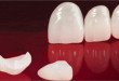 Hot răng sứ cercon có tốt không>>> Giải đáp từ chuyên gia