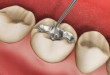 Hàn răng sâu có đem lại hiệu quả như bạn nghĩ?