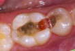 Cách điều trị sâu chân răng hiệu quả không thể ngờ >>> Xem ngay