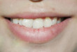 Làm sao để khắc phục răng cửa mọc lệch hiệu quả nhất?