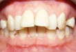 Làm sao để răng hết hô? >>>> Giải pháp cho răng hô