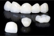 Quy trình bọc răng sứ Cercon theo đúng tiêu chuẩn quốc tế