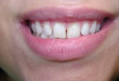 Nguyên nhân răng thưa dần và cách khắc phục SIÊU HIỆU QUẢ