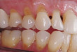Những tác hại của tật nghiến răng