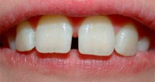 Bọc răng sứ alumina cho hàm răng thưa có tốt không? 