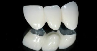 Răng sứ cercon và những điều bạn nên hiểu rõ