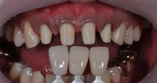 Bọc răng là gì? Những lưu ý quan trọng về bọc răng cần biết ngay.
