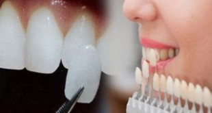 Dán răng sứ thẩm mỹ – Giải pháp cho hàm răng trắng đẹp tự nhiên nhất