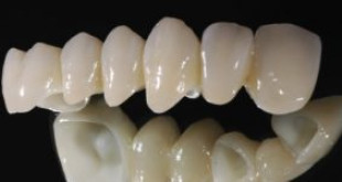 Răng sứ venus cho hàm răng trắng đều vượt thời gian