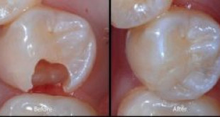 Bọc răng hàm có thực sự cần thiết và nên tiến hành hay không?