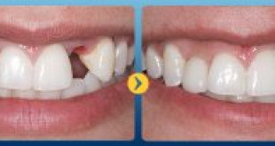 Có nên làm cầu răng trong trường hợp mới bị mất răng?