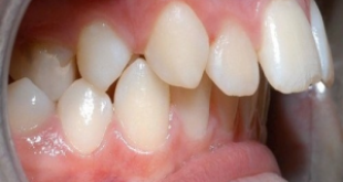 Giải pháp cho răng hơi hô có nên niềng không?