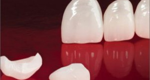 Răng sứ cercon: Dòng răng hội tụ của thẩm mỹ sang trọng và đẳng cấp