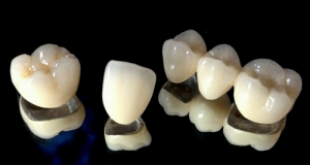 Bọc răng sứ titan có tốt không và độ bền răng sứ titan như thế nào?
