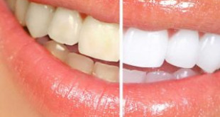 Tác dụng của phương pháp làm răng sứ thẩm mỹ