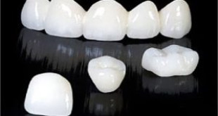 Bật mí cho bạn sự thật về tuổi thọ của răng sứ titan