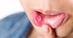 Những cách trị bệnh lở miệng THẦN KỲ không phải ai cũng biết