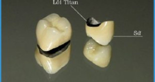 Chuyên gia tư vấn: Bọc răng sứ Titan có tốt và bền không?