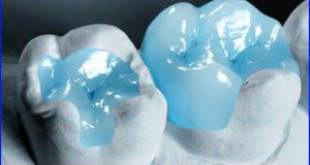 Trám răng có đau không? Bác sĩ nha khoa tư vấn