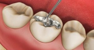 Hàn răng sâu có đem lại hiệu quả như bạn nghĩ?
