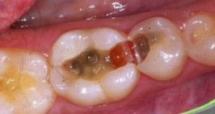 Cách điều trị sâu chân răng hiệu quả không thể ngờ >>> Xem ngay