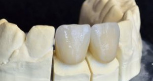 Có nên bọc răng sứ Emax không? Răng sứ Emax bền không?