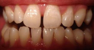 “HOT” phương pháp làm lại răng cửa hiệu quả nhất trên thế giới