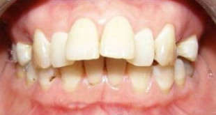 [Giải Đáp Thắc Mắc] – Có nên bọc răng sứ cho răng vẩu không?