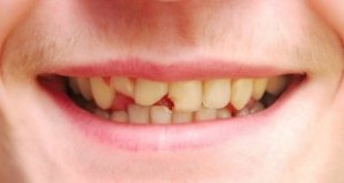 Top những nguyên nhân bị mẻ răng bạn không nên bỏ qua