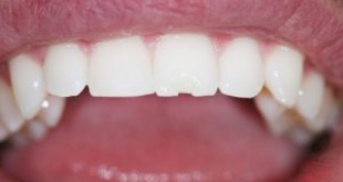 Làm gì khi bị mẻ răng? >>> Giải pháp cho răng bị mẻ