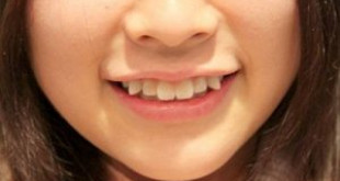 Có nên mài răng khểnh cho răng đẹp hơn không?