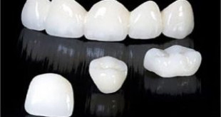 Quy trình bọc răng sứ Cercon theo đúng tiêu chuẩn quốc tế