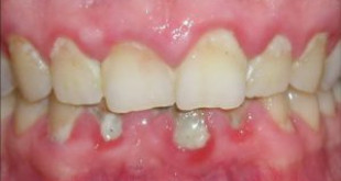 Những bệnh răng miệng liên quan tới sức khỏe cơ thể