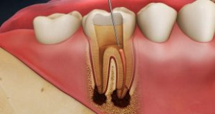 Làm răng sứ lấy tủy có cần không? Quy trình này thực hiện ra sao?