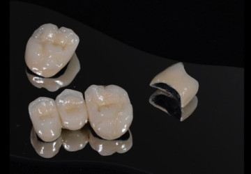 Răng sứ kim loại trong phục hình răng thẩm mỹ: Có nên không?