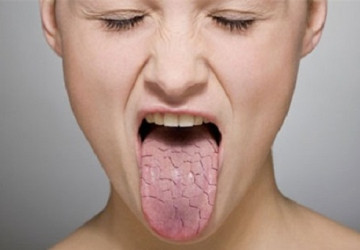Bệnh khô miệng và cách điều trị triệt để bệnh