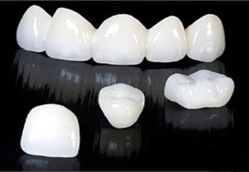 Bật mí cho bạn răng sứ titan tốt không và độ bền răng sứ titan